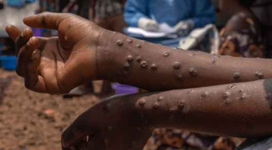 Mpox Virus Cases in Mozambique Surges - The State Signal
