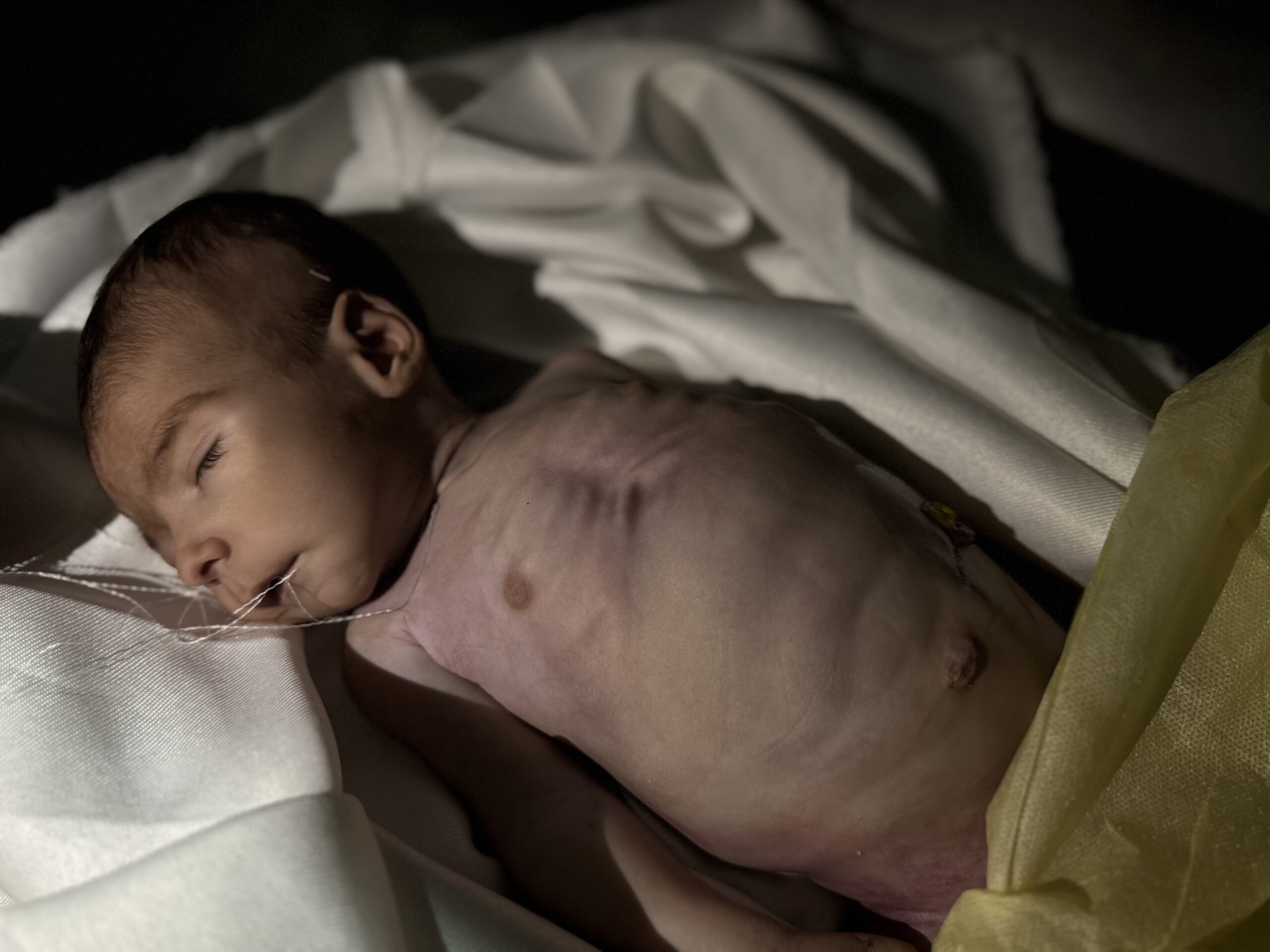 Gaza Famine Results to 5 More Deaths in Last 24 Hours - The State Signal
