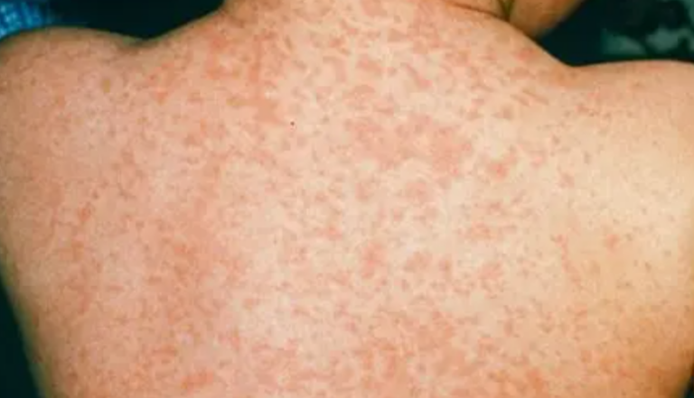 Measles Cases in Australia 2025, Compared to 2024 - The State Signal