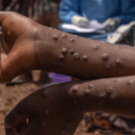 Mpox no Longer a Health Emergency in Africa; CDC - The State Signal