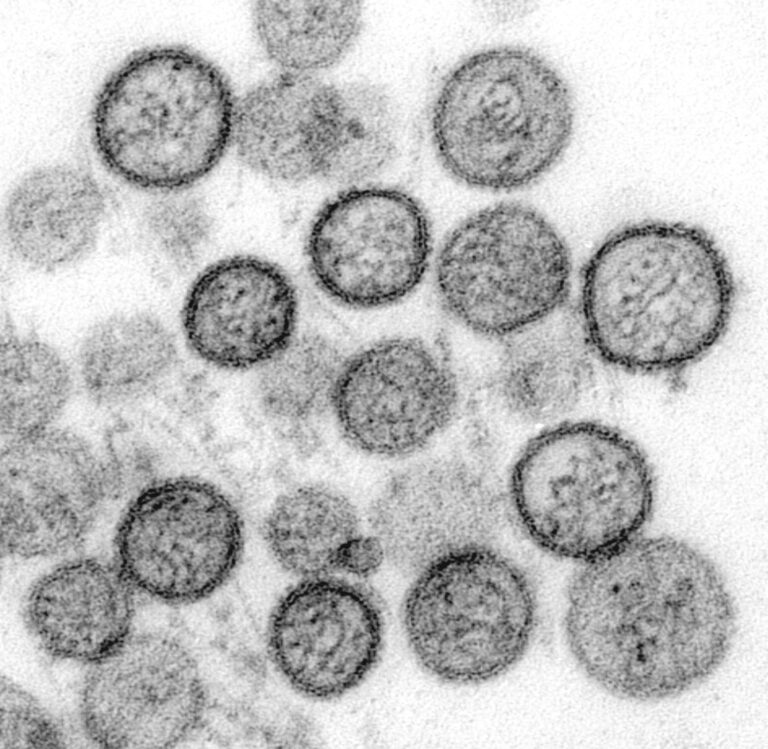 Illness Caused by Andes Strain of Hantavirus Designated a Public Health Risk in Finland - The State Signal